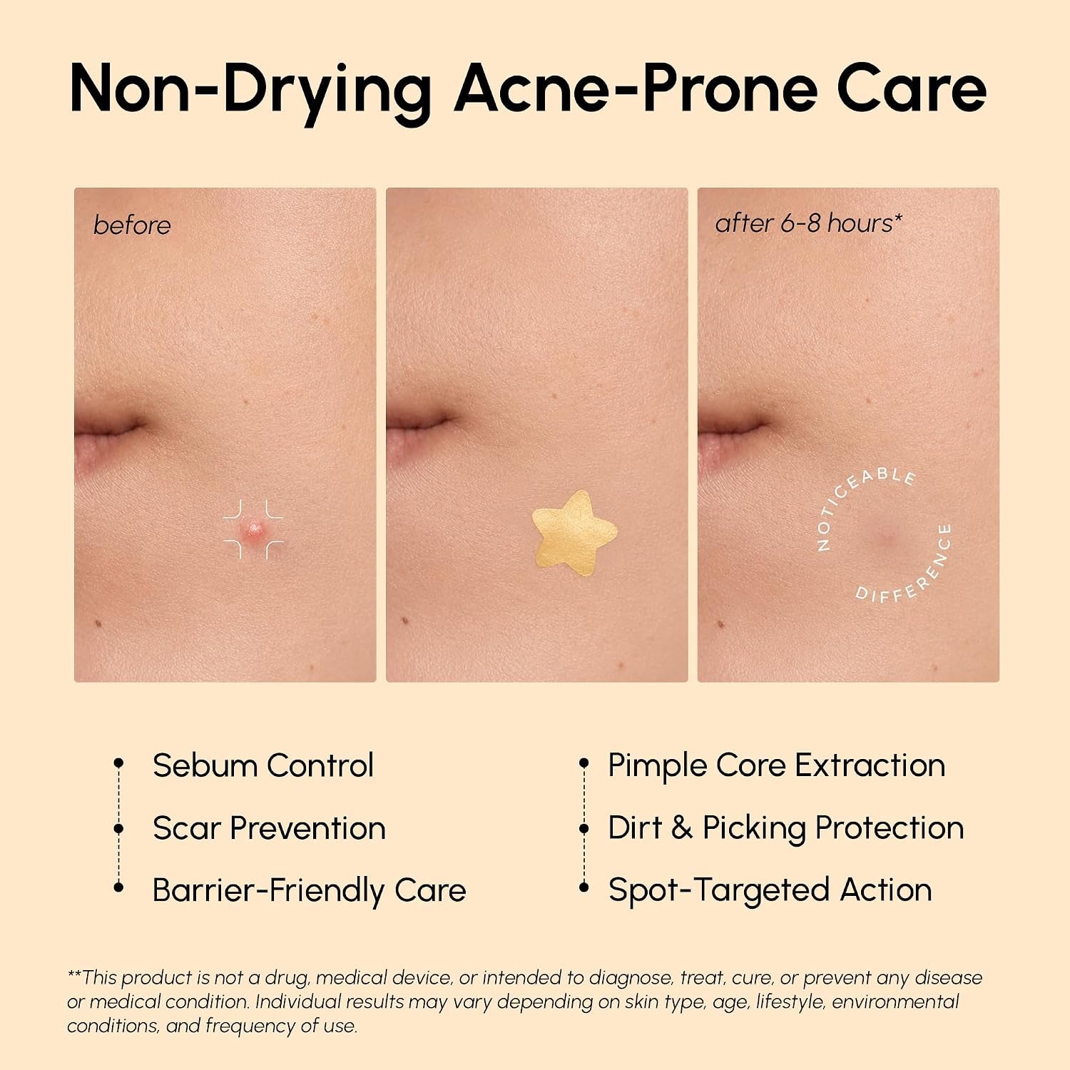 Gold Star Pimple Patches for Face - Acne Patches Stars with Salicylic Acid - Cute Hydrocolloid Pinple Patch for Kids, Teens, Adults Large Zit Stickers 72 Count (Pack of 1)